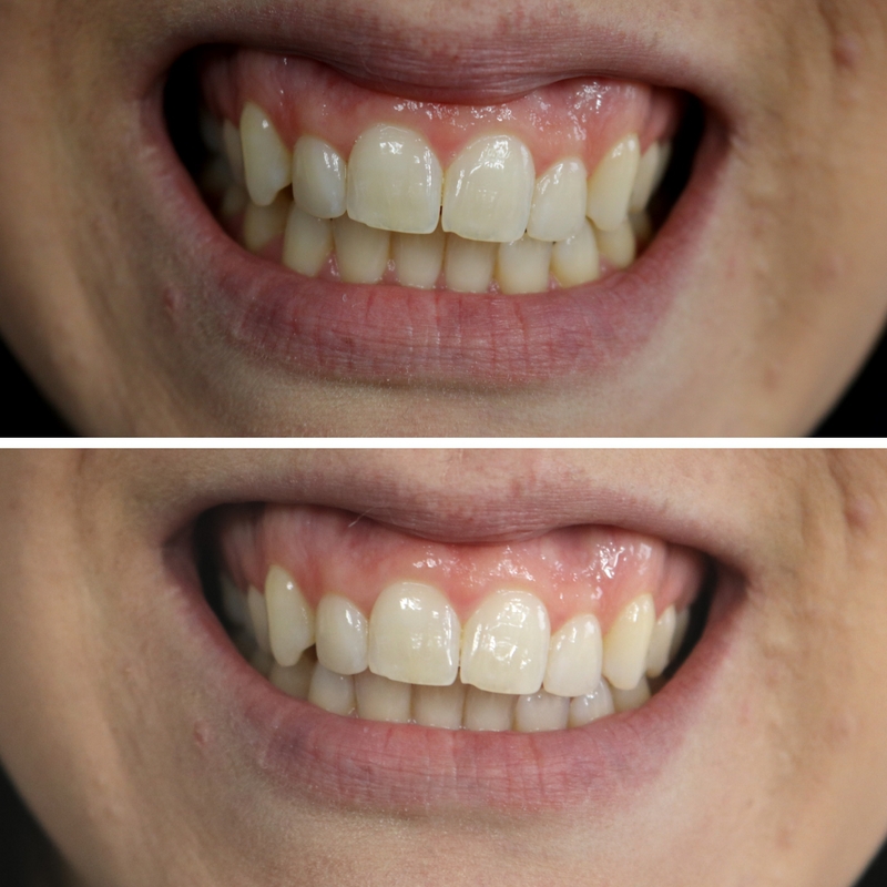 It can be tricky to figure out what works or how to whiten your teeth but this method is simple, just 2 ingredients! Instant results after just 2 minutes! How to Whitten Teeth | How to Get White Teeth | How to Properly Brush Your Teeth | How to Get a Better Smile 